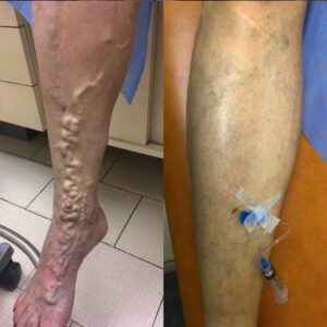Before and after sclerotherapy A total of 5 treatments on this patient.