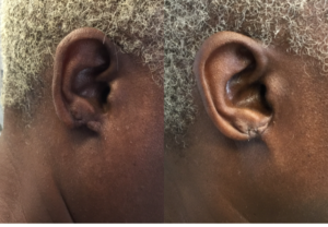 Torn ear lobe solutions, monster backs and more